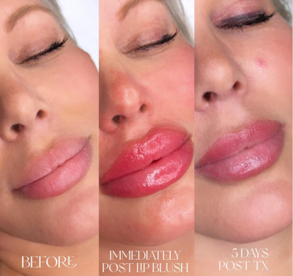 Llenadores cutáneos ácidos hialurónicos profundos de los labios 2ml de Skinject inyectables