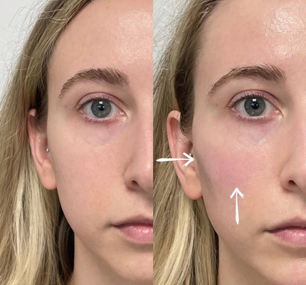 Llenadores cutáneos ácidos hialurónicos profundos de los labios 2ml de Skinject inyectables