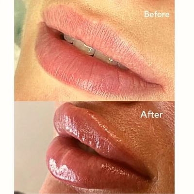 Inyección inyectable Juvederms del llenador llenador cutáneo de ultra 3 has para el volumen del labio