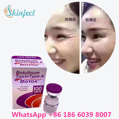 La toxina Botulinum  arruga el retiro 100u Allergan 100 unidades para la inyección del lifting facial