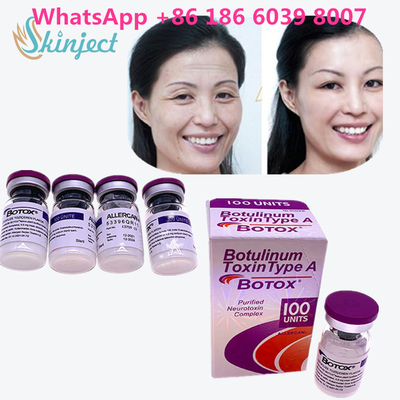La toxina Botulinum  arruga el retiro 100u Allergan 100 unidades para la inyección del lifting facial
