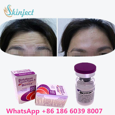 La toxina Botulinum  arruga el retiro 100u Allergan 100 unidades para la inyección del lifting facial