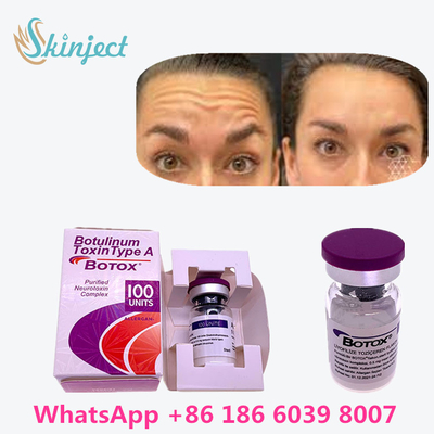 La toxina Botulinum original  100u del 100% para quita arrugas