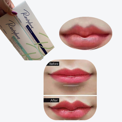 2*1ml/ Caja Relleno dérmico de ácido hialurónico para aumento de labios