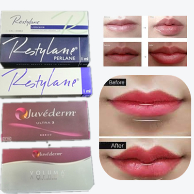 2*1ml/ Caja Relleno dérmico de ácido hialurónico para aumento de labios
