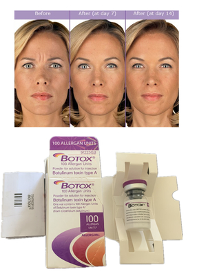 Allergan Botulax  Toxina Botulínica 100IU Antiarrugas Relleno dérmico