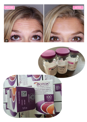 Toxina Botulínica Antirrugas Allergan 100IU 150iu Inyecciones de  ' Na