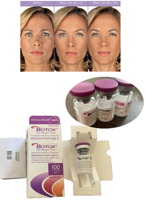 Anti-arrugas  Botulinum Toxin Allergan 100IU 150iu ' Na y otras sustancias
