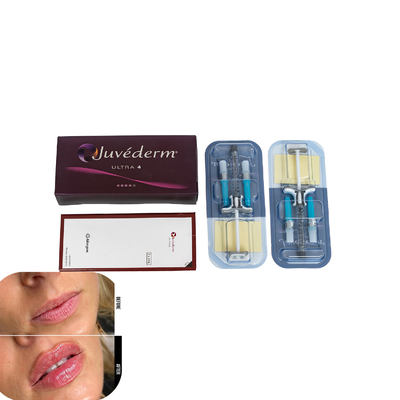 Juvederm Relleno dérmico para labios Rellenes de ácido hialurónico inyectables