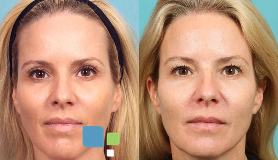 Relleno de inyección 3D PLLA para la regeneración del colágeno facial