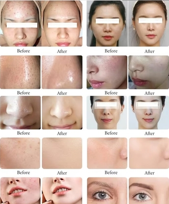 11 en 1 Máquina hidráulica multifuncional para dermoabrasión facial Perla Negra Limpieza facial Dispositivo para el cuidado de la piel