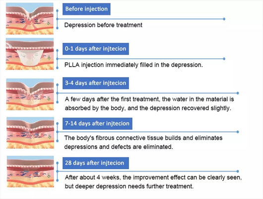 PLLA Ácido poli- L- láctico para inyección facial 10 viales 150 mg