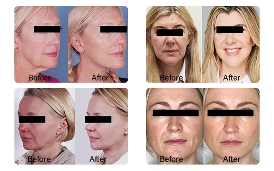 PLLA Ácido poli- L- láctico para inyección facial 10 viales 150 mg