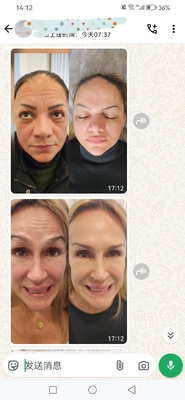 Dysport Cosmético 500 Unidades Toxina Botulínica 500 UI Polvo para inyección