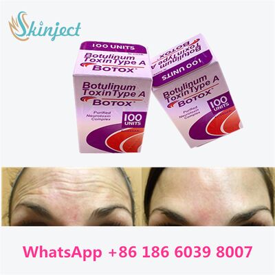 Botox de Allergan, Toxina Botulínica Tipo A, 100 Unidades para Eliminación de Arrugas con Duración de 4 a 6 Meses