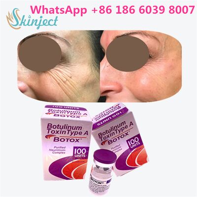 Botox de Allergan, Toxina Botulínica Tipo A, 100 Unidades para Eliminación de Arrugas con Duración de 4 a 6 Meses