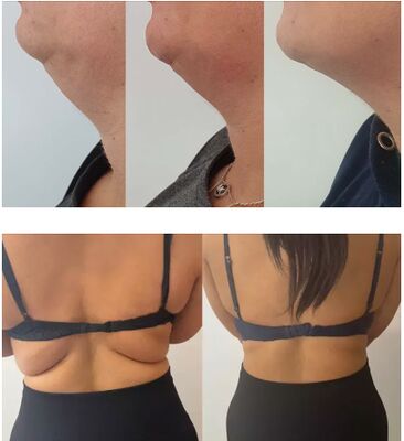 Natural Lemon Bottle Fat Dissolving Solution Lipolytic Solution