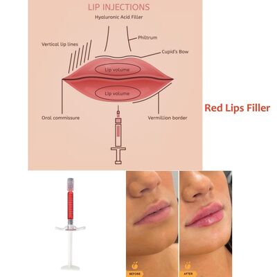 Tiempo de recuperación inmediato Revolax Deep Filler Excelente para mejorar los labios Proporcionando resultados naturales y tiempo de inactividad mínimo