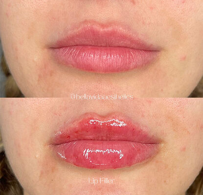 Período de validez 2 años Gel inyectable de relleno dérmico diseñado para la reducción de arrugas, contorno facial y revitalización de la piel