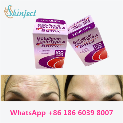 Toxina Botulínica Alérgico BOTOX Inyección Cosmética 100 Unidades para líneas Glabellares