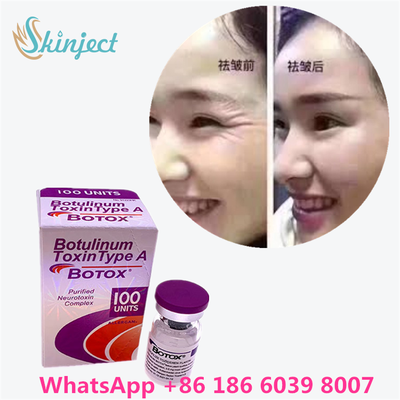 Toxina Botulínica Allergan Botox Polvo Blanco Tratamiento Efectivo para Líneas Faciales y Relajación Muscular en Medicina