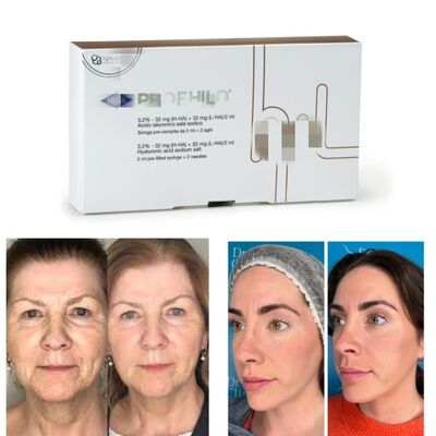 Tratamiento Profhilo Ácido Hialurónico Bioestimulador y Bio-remodelación