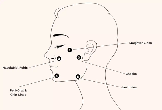 Tratamiento Profhilo Ácido Hialurónico Bioestimulador y Bio-remodelación