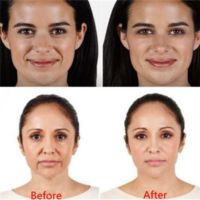 Arrugas ácidas hialurónicas de Juvaderm Voluma Pen Filler For Forehead Eyes