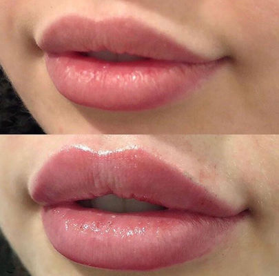 Labios rusos Juvederm ultra 3 con el llenador cutáneo ligado cruz de la lidocaína