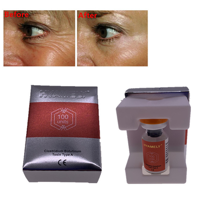 Inyecciones antienvejecedoras de Hyamely  para las arrugas de la cara