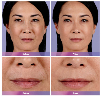 Inyección cutánea ultra 4 del labio del llenador de Juvederm para la ampliación del labio