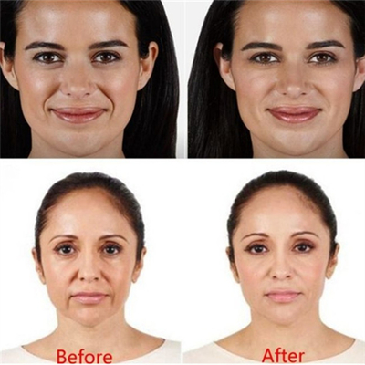 Las inyecciones cutáneas del labio del llenador de la ha 2ml arrugan el llenador Juvederm inyectable