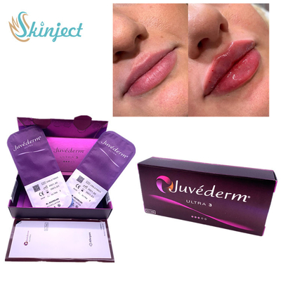 Llenador cutáneo nasolabial Juvederm ácido hialurónico Ultra3 de los labios 2x1ml de los dobleces