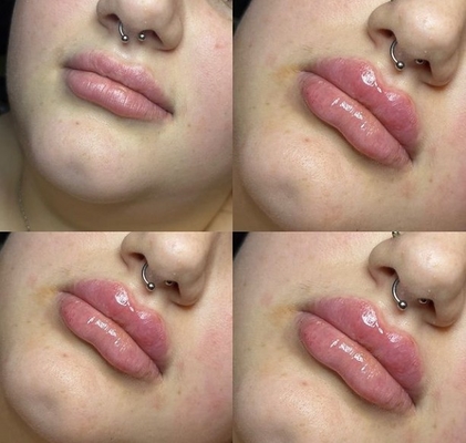El Ce cutáneo profundo de las inyecciones del labio del llenador de Revolax ha marcó