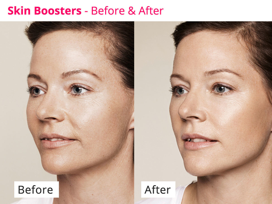 Piel que rejuvenece el suero meso de PDRN Skinbooster para la regeneración del colágeno