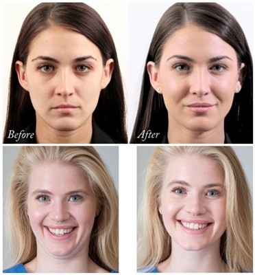 Llenador facial ácido hialurónico de Juvederm Voluma de la mejora 24 mg/ml