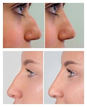 Llenador facial ácido hialurónico de Juvederms Voluma para el aumento de Chin y de la mejilla