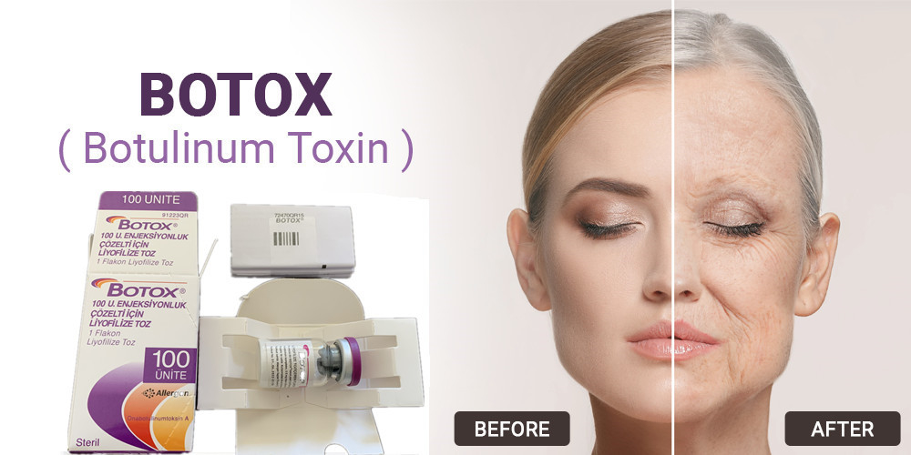 tipo Botulinum de la toxina de 100Units Allergan una inyección para el retiro facial de la arruga