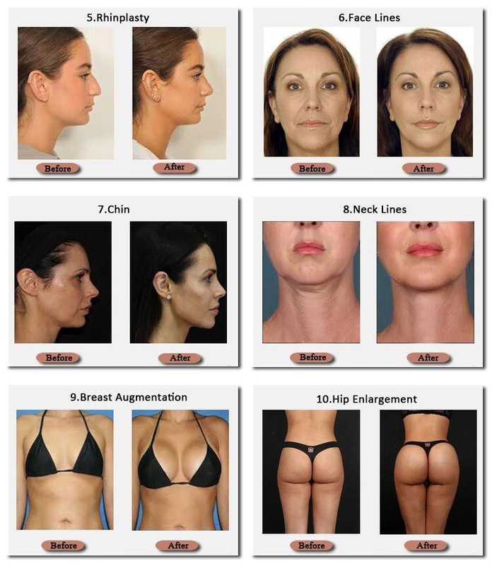 Skinjection llenador hialurónico Technnology coreano del pecho de 10 ml y de 20 ml 24 mg/ml