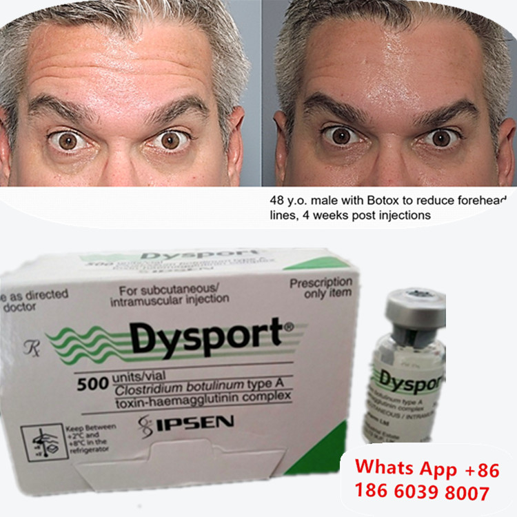 Toxina Botulínica Dysport Botox Clostridium Botulinum Tipo A Para Levantamiento de Cejas