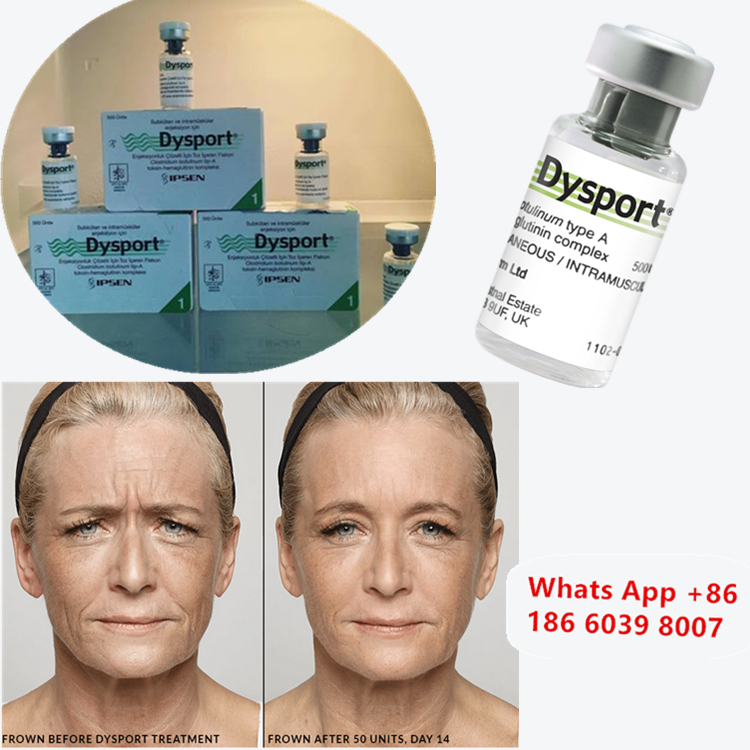 Dysport 500u Toxina Botulínica Tipo A para el realce de mejillas