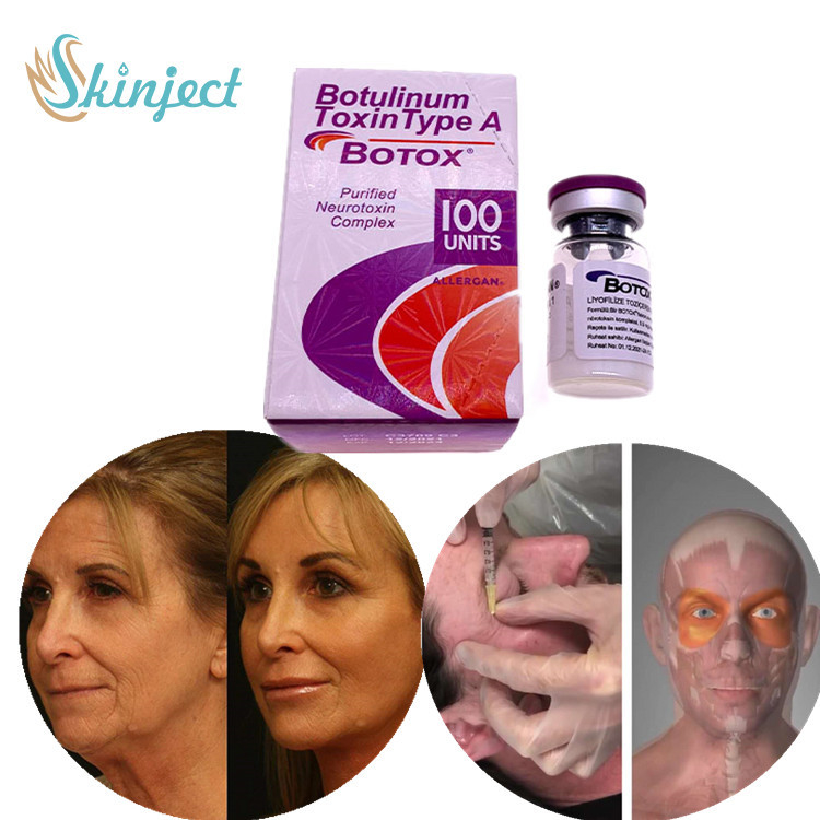 Tipo Botulinum facial de la toxina un retiro de la arruga de la inyección