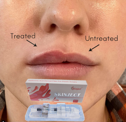 Mejilla cutánea ácida hialurónica profunda inyectable Chin Nasolabial Fold del llenador del labio 2ml