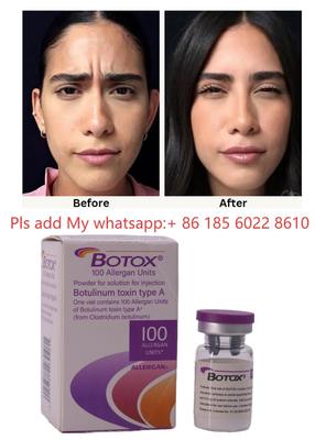 ALLERGAN Inyección de Botox Toxina Botulínica Tipo A